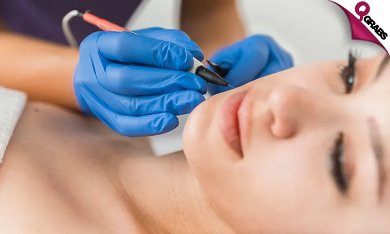 Electrolysis Permanent Hair Removal!
